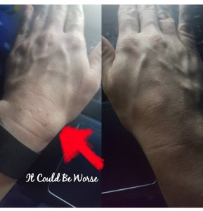 Lumpy, the Ganglion Cyst, A Trilogy - It Could Be Worse - Mary Horsley