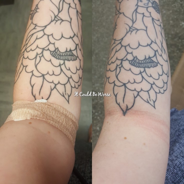 Allodynia - Another week in my Crohn's journey - it could be worse blog - Mary Horsley