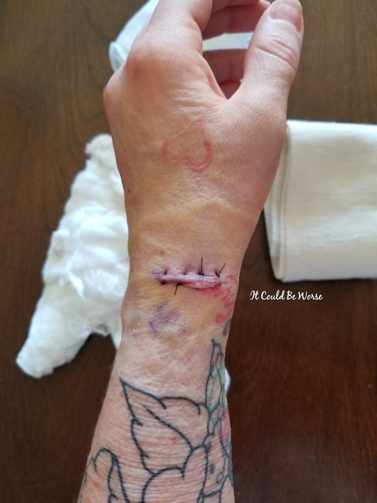 Lumpy, the Ganglion Cyst, A Trilogy - It Could Be Worse - Mary Horsley