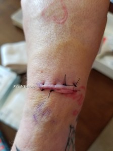 Stelara Self-Injection #1 | It Could Be Worse Blog