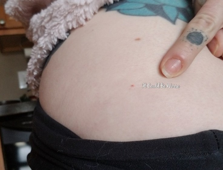 Stelara Infusion & Ganglionectomy Pain - It Could Be Worse - Mary Horsley