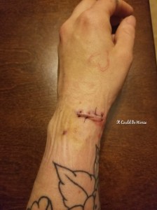 My Ganglion Cyst - The Tetralogy | IT COULD BE WORSE BLOG