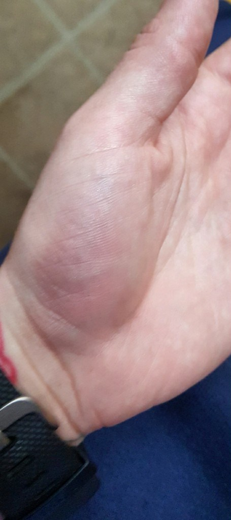 Lumpy, the Ganglion Cyst, A Trilogy - It Could Be Worse - Mary Horsley