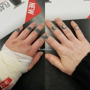 Stelara Infusion & Ganglionectomy Pain - It Could Be Worse - Mary Horsley