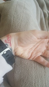 May Delays | It Could Be Worse Blog | Mary Horsley - Ganglion cyst