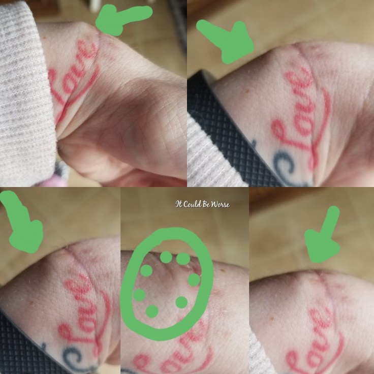 Stelara Self-Injection #1 | It Could Be Worse Blog