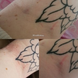 Stelara Self-Injection #1 | It Could Be Worse Blog