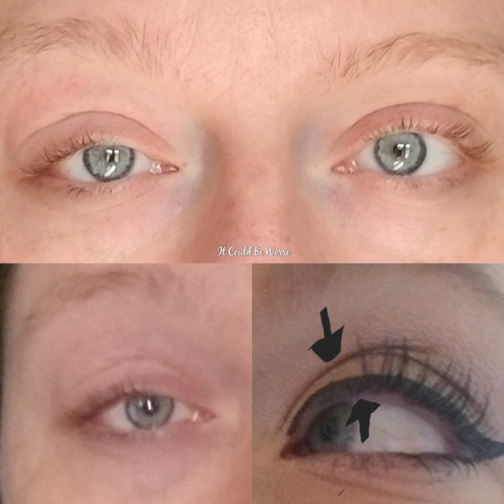 Stelara Self-Injection #1 | It Could Be Worse Blog