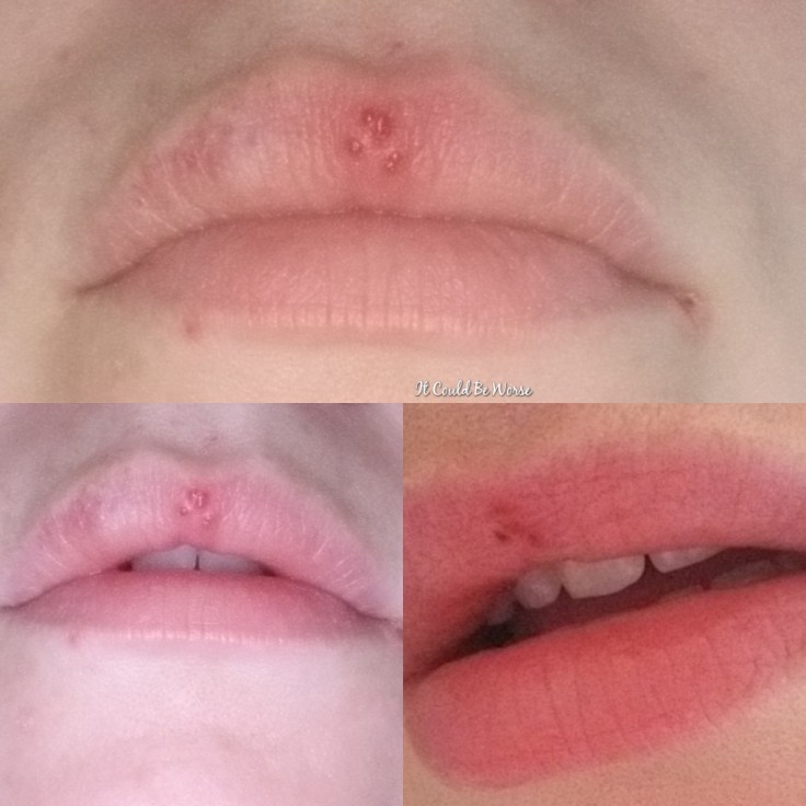 Stelara Self-Injection #1 | It Could Be Worse Blog