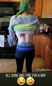 My Wonky Ribs and Neurectomy | IT COULD BE WORSE BLOG