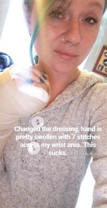 My Ganglion Cyst - The Tetralogy | IT COULD BE WORSE BLOG