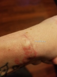My Ganglion Cyst - The Tetralogy | IT COULD BE WORSE BLOG