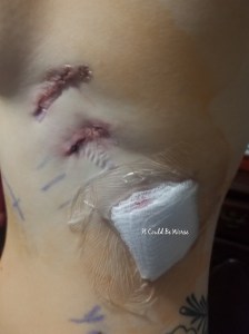 My Wonky Ribs and Neurectomy | IT COULD BE WORSE BLOG