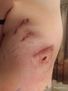 My Wonky Ribs and Neurectomy | IT COULD BE WORSE BLOG