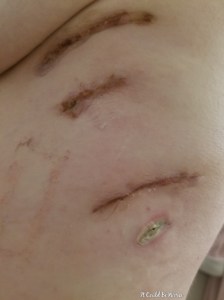 My Wonky Ribs and Neurectomy | IT COULD BE WORSE BLOG