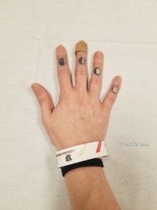 My Wonky Ribs and Neurectomy | IT COULD BE WORSE BLOG