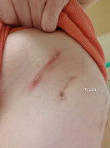 My Wonky Ribs and Neurectomy | IT COULD BE WORSE BLOG