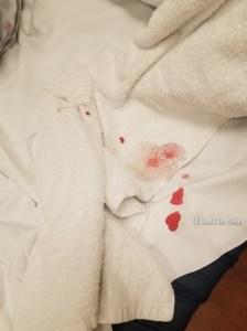 My Wonky Ribs and Neurectomy | IT COULD BE WORSE BLOG