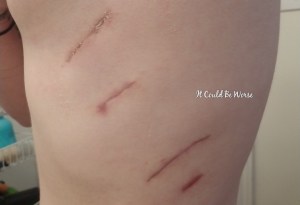 Rib Plating Surgery and Thoracic Appointments | IT COULD BE WORSE BLOG