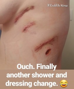 My Wonky Ribs and Neurectomy | IT COULD BE WORSE BLOG