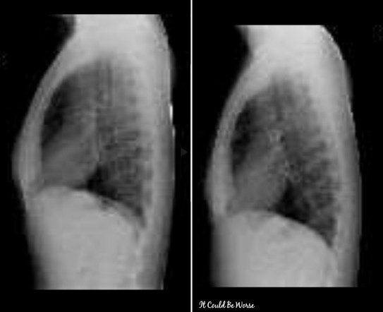 My Wonky Ribs and Neurectomy | IT COULD BE WORSE BLOG