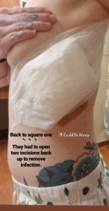 My Wonky Ribs and Neurectomy | IT COULD BE WORSE BLOG