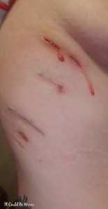 Rib Plating Surgery and Thoracic Appointments | IT COULD BE WORSE BLOG