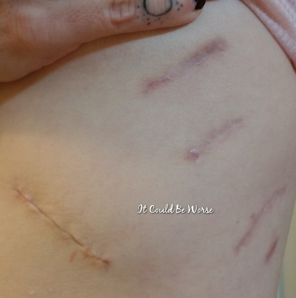 Rib Plating Surgery and Thoracic Appointments | IT COULD BE WORSE BLOG