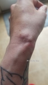 My Ganglion Cyst - The Tetralogy | IT COULD BE WORSE BLOG