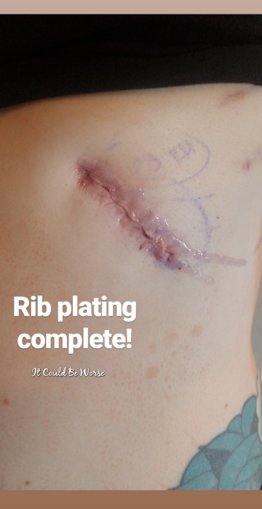 Rib Plating Surgery and Thoracic Appointments | IT COULD BE WORSE BLOG