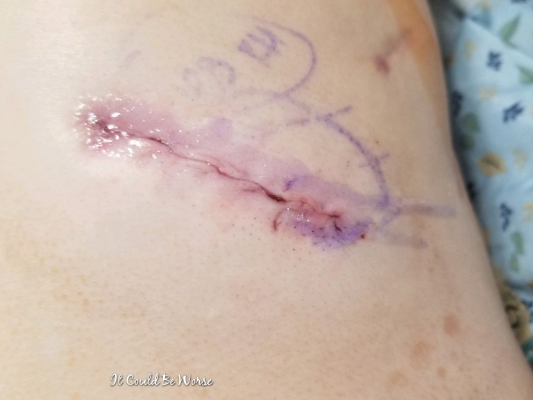 Rib Plating Surgery and Thoracic Appointments | IT COULD BE WORSE BLOG