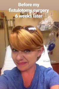 Perianal Abscess #2 in My Crohn's Disease Journey | IT COULD BE WORSE BLOG - Mary Horsley has fistulotomy