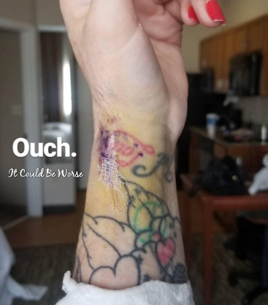 De Quervain's Tenosynovitis - Lefty | IT COULD BE WORSE BLOG