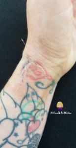 De Quervain's Tenosynovitis - Lefty | IT COULD BE WORSE BLOG