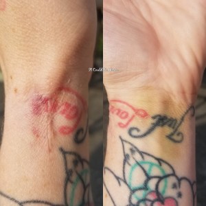 De Quervain's Tenosynovitis - Lefty | IT COULD BE WORSE BLOG