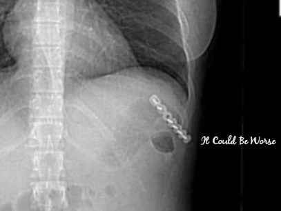 Thoracic Follow-Up & Slipping Rib Syndrome | IT COULD BE WORSE BLOG