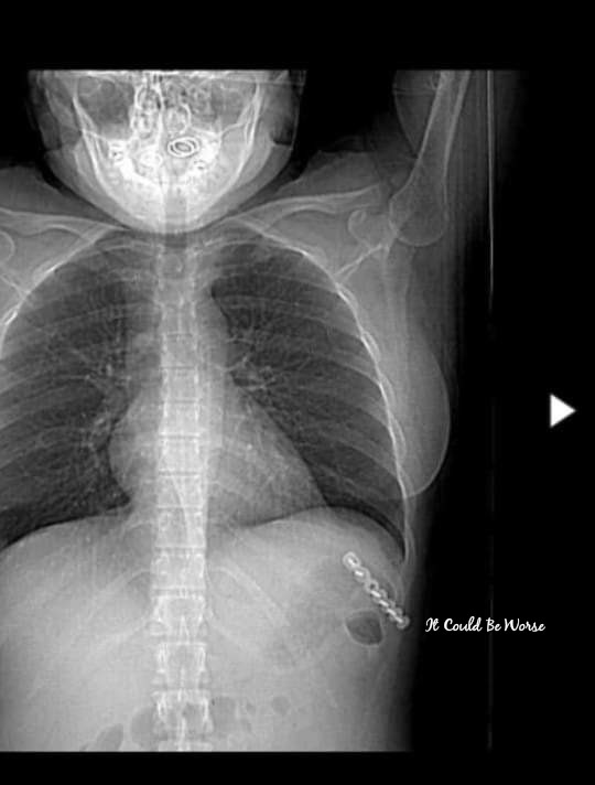 Thoracic Follow-Up & Slipping Rib Syndrome | IT COULD BE WORSE BLOG