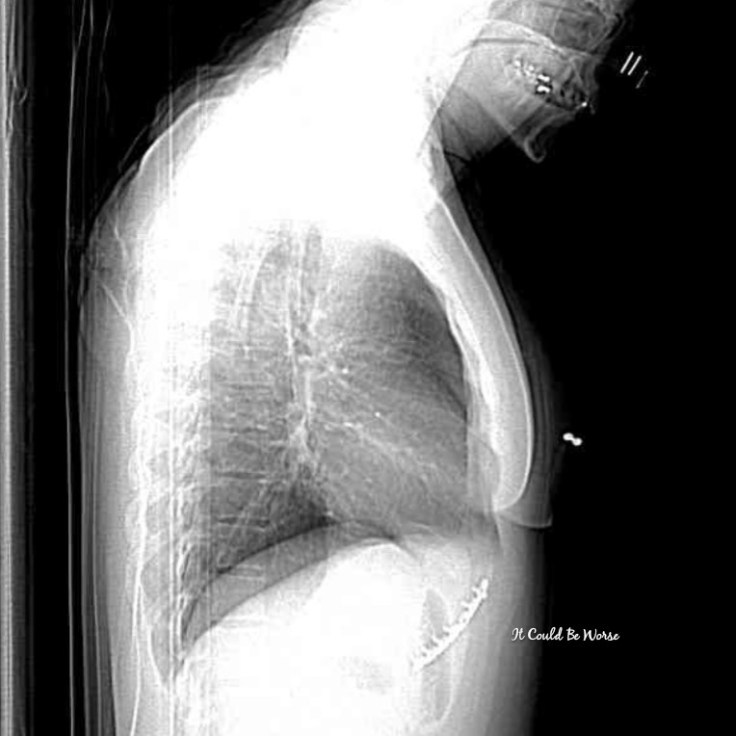 Thoracic Follow-Up & Slipping Rib Syndrome | IT COULD BE WORSE BLOG