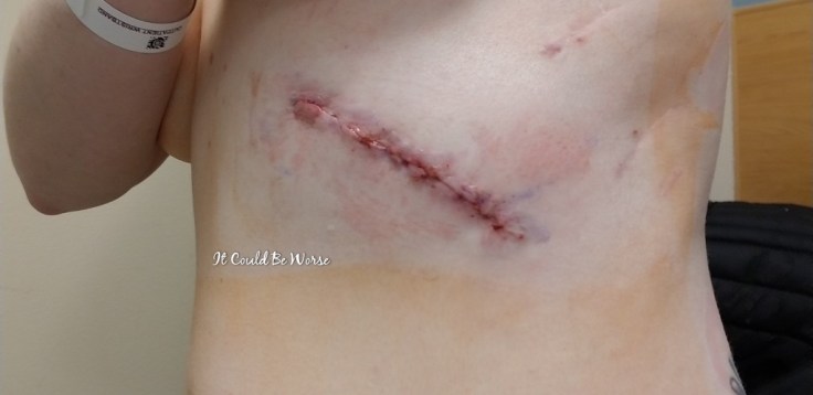 Slipping Rib Syndrome | IT COULD BE WORSE BLOG