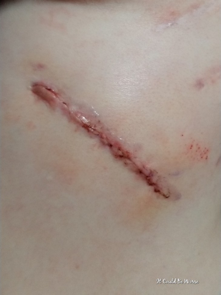 Any Way You Slice It - Thoracic & Hand Surgery, Again