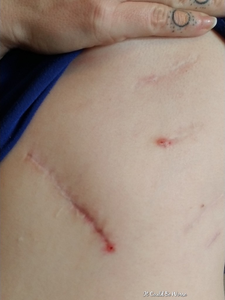 3 Months Post-Op Slipping Rib Syndrome