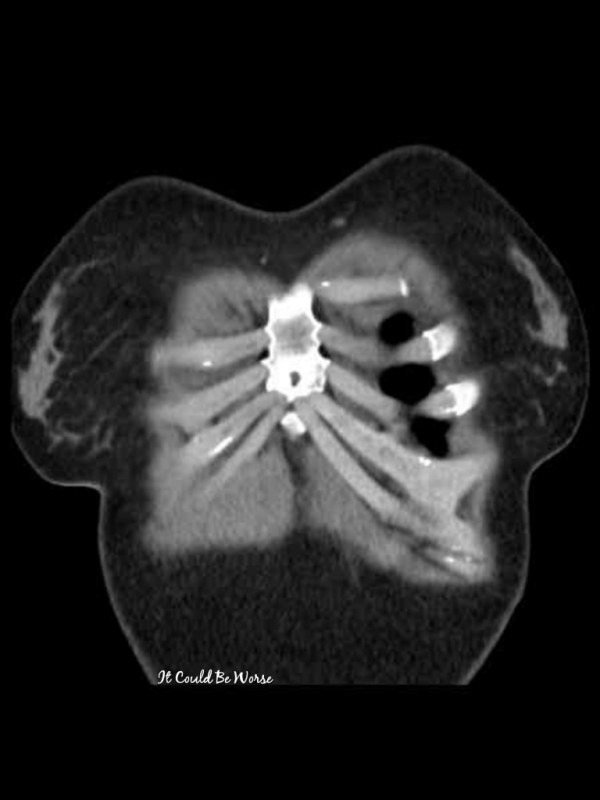Any Way You Slice it -Thoracic Surgery, Again
