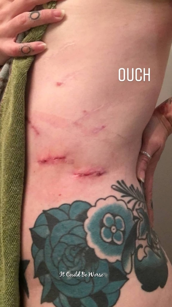 Seven Scars & My 10th Procedure