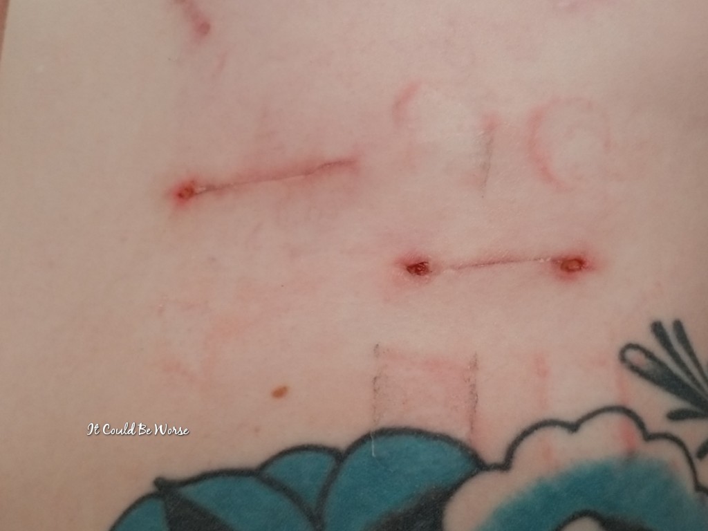 Seven Scars & My 10th Procedure
