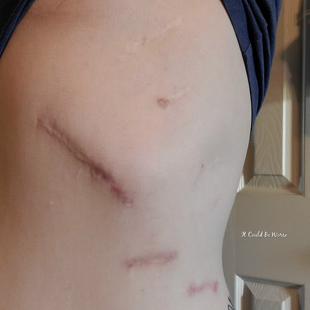 Goodbye 2020, Hello 2021 mary horsley slipping rib syndrome cardio thoracic surgery neurectomy rib plating rib resection it could be worse blog