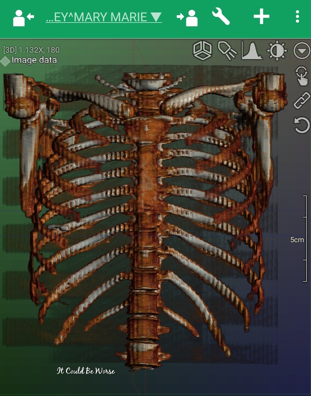 3 Years & 5 Surgeries- Slipping Rib Syndrome