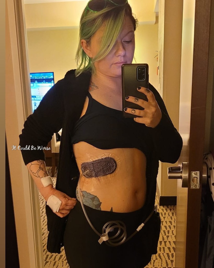 Slipping Rib Syndrome - Hansen Technique & One Month Follow-Up