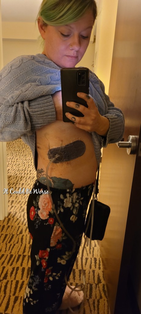 Slipping Rib Syndrome - Hansen Technique & One Month Follow-Up