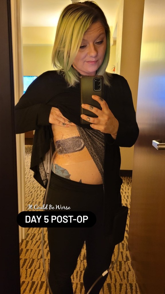 Slipping Rib Syndrome - Hansen Technique & One Month Follow-Up