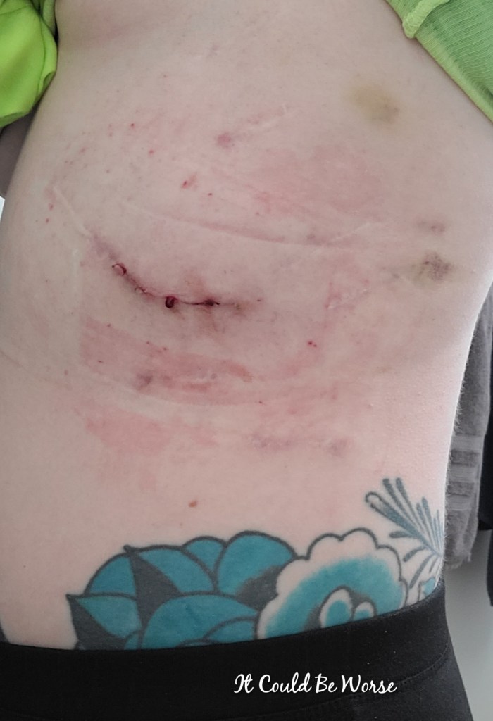 Slipping Rib Syndrome - Hansen Technique & One Month Follow-Up